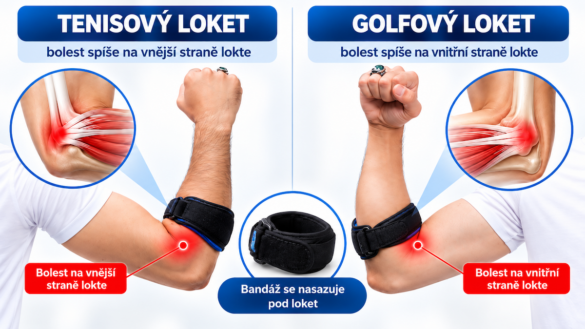 Tenisový a golfový loket – rozdíl a umístění bandáže
